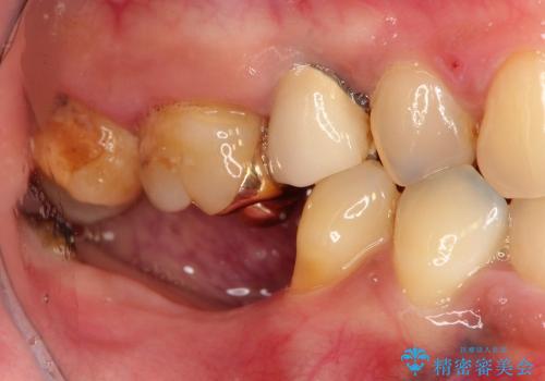 歯ぐきの状態を改善した奥歯インプラント治療の治療前