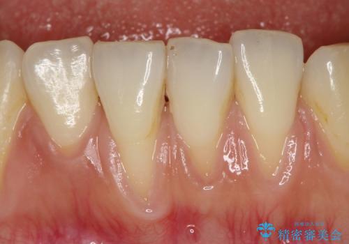 下顎前歯の歯茎再生の治療前