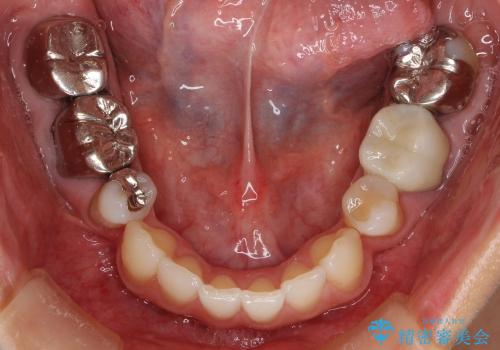 金属アレルギー:メタルフリー治療(銀歯をセラミックに)の治療前