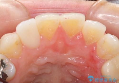オールセラミッククラウンによる前歯の歯並びの審美的改善の治療後