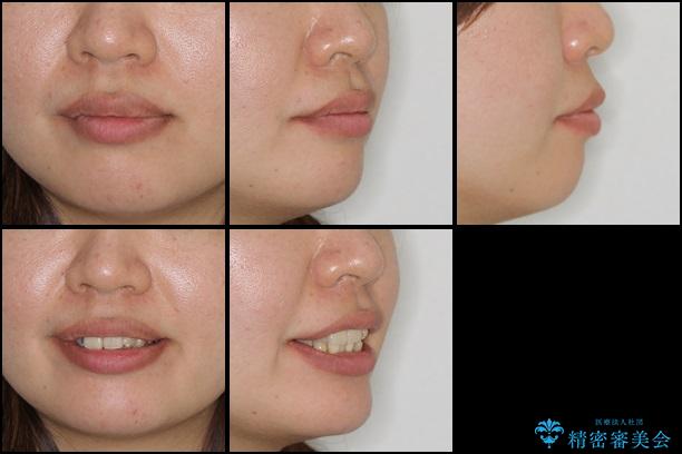 30代女性 八重歯を治したい 審美装置の治療前（顔貌）