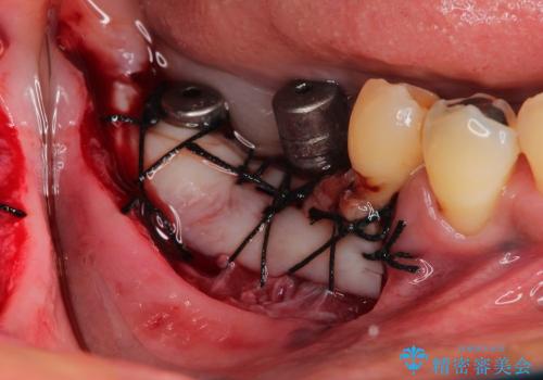 歯ぐきの状態を改善した奥歯インプラント治療の治療中