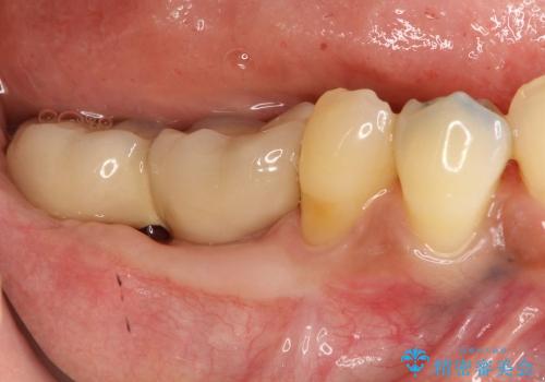 歯ぐきの状態を改善した奥歯インプラント治療の治療後