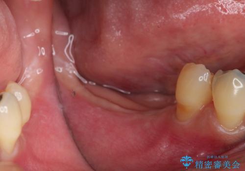 歯ぐきの状態を改善した奥歯インプラント治療の治療前