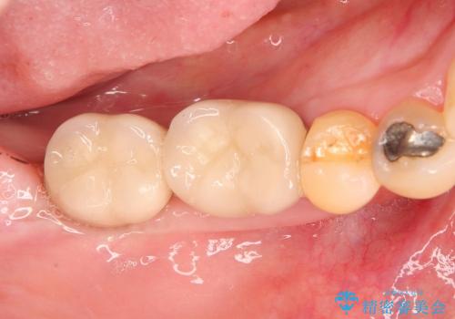 歯ぐきの状態を改善した奥歯インプラント治療の治療後