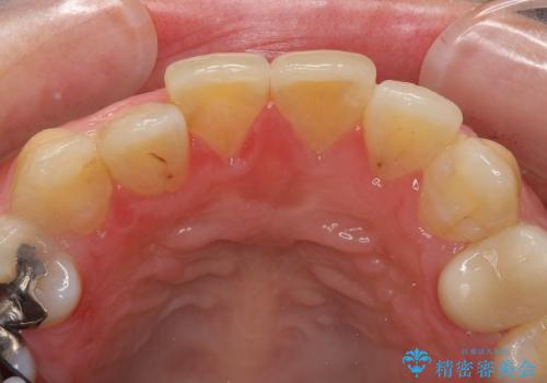 オールセラミッククラウンによる前歯の歯並びの審美的改善の治療前
