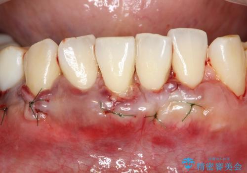 下顎前歯の歯茎再生の治療中