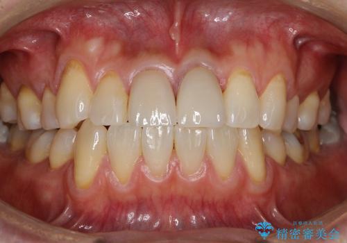 前歯の被せ物再治療の治療後
