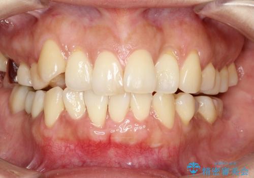 下顎前歯の歯茎再生の治療後