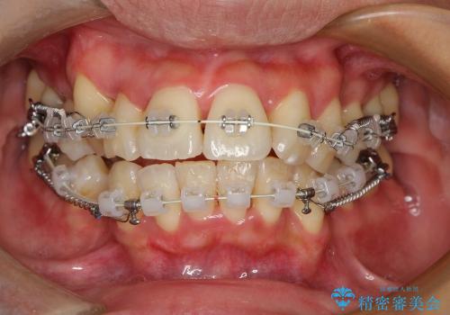 30代女性 八重歯を治したい 審美装置の治療中