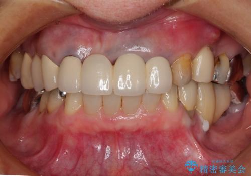 抜歯後の審美的ブリッジ治療の治療前
