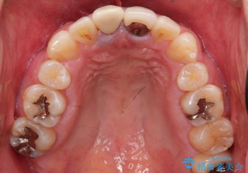 前歯の被せ物再治療の治療前