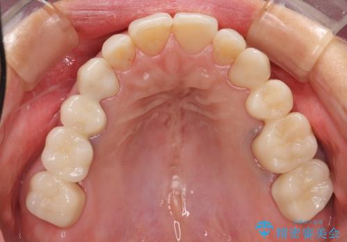 金属アレルギー:メタルフリー治療(銀歯をセラミックに)の治療後