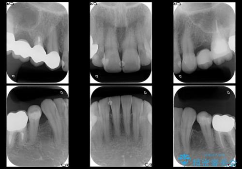金属アレルギー:メタルフリー治療(銀歯をセラミックに)の治療後