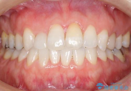 オールセラミッククラウンによる前歯の歯並びの審美的改善の治療後