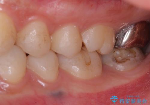 [銀歯を全てセラミックに変えたい] 奥歯のセラミック治療の治療前