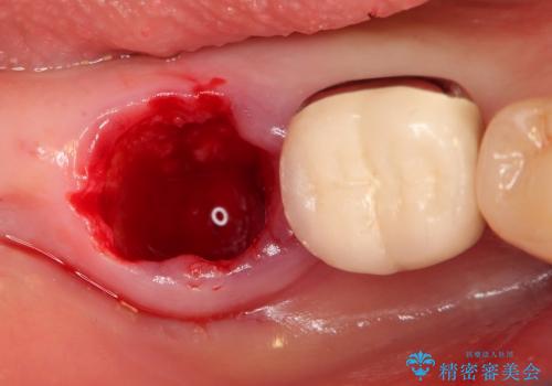 銀歯の下の虫歯の再発・進行の治療後