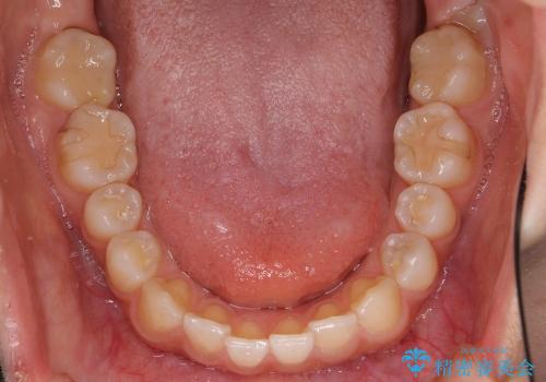 [銀歯を全てセラミックに変えたい] 奥歯のセラミック治療の治療後