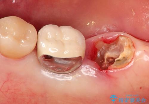 銀歯の下の虫歯の再発・進行の治療中
