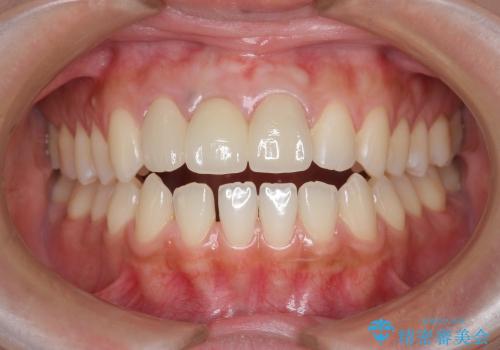 歯ぐきの状態を改善した,前歯ブリッジの再作製の治療後