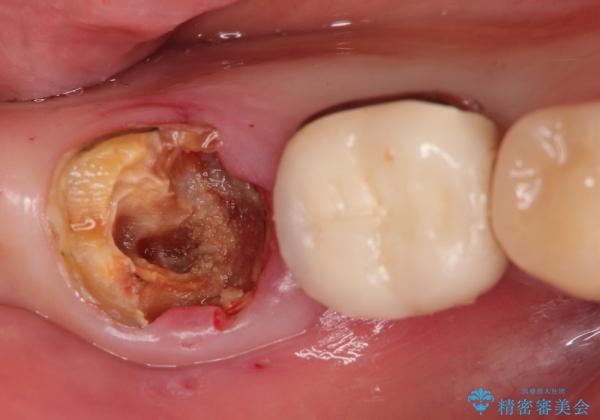 銀歯の下　虫歯の再発