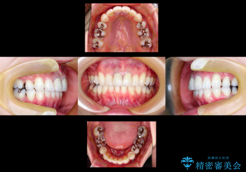 30代女性　八重歯を治したい　矯正&セラミックによる治療の治療後