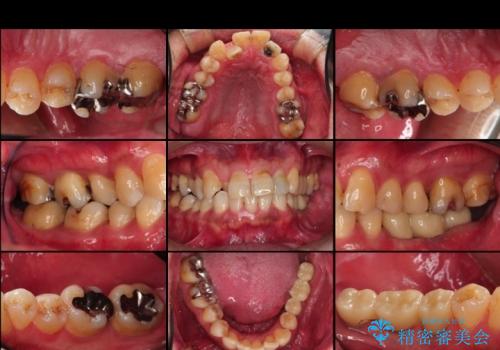 奥歯3本のインプラント治療(50代 男性)の治療後