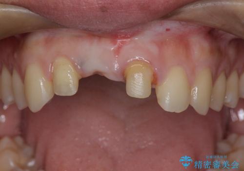 歯ぐきの状態を改善した,前歯ブリッジの再作製の治療中