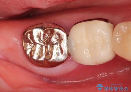 銀歯の下の虫歯の再発・進行の治療前