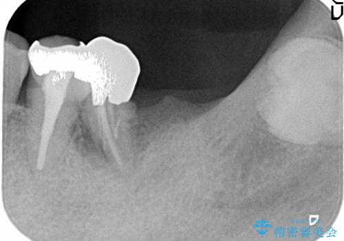 奥歯3本のインプラント治療(50代 男性)の治療前
