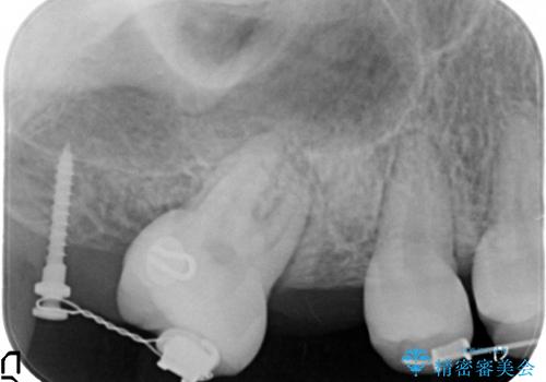 20代女性 奥歯の部分矯正の一例の治療前