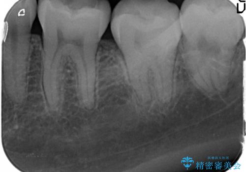 [銀歯を全てセラミックに変えたい] 奥歯のセラミック治療の治療後
