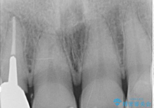 20代女性 前歯の部分矯正+オールセラミックの治療前