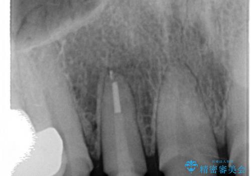 20代女性 前歯の部分矯正(extrusion)の治療後