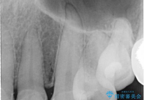 20代女性 前歯の部分矯正+オールセラミックの治療後