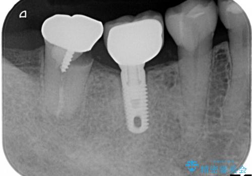 銀歯の下の虫歯の再発・進行の治療前