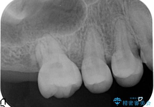 20代女性 奥歯の部分矯正の一例の治療後