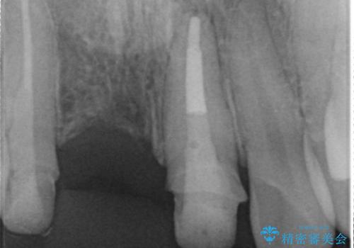 歯ぐきの状態を改善した,前歯ブリッジの再作製の治療中