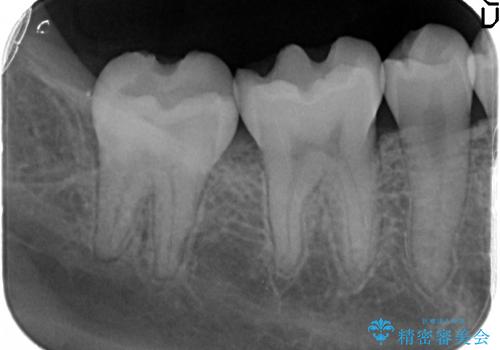 [銀歯を全てセラミックに変えたい] 奥歯のセラミック治療の治療前