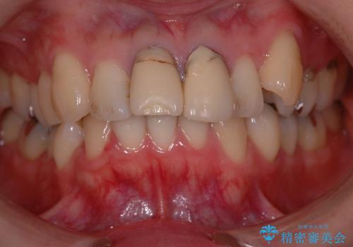 30代女性　八重歯を治したい　矯正&セラミックによる治療の治療前