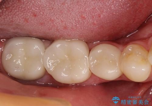 30代男性 奥歯の虫歯治療→セラミックによる修復の治療後