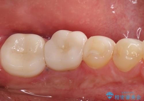 30代男性 奥歯の虫歯治療→セラミックによる修復の治療後