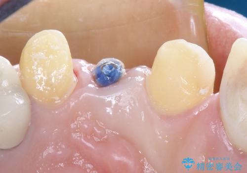 20代女性 前歯の部分矯正(extrusion)の治療前