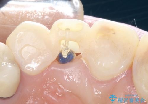 20代女性 前歯の部分矯正(extrusion)の治療前