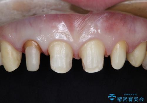 20代女性 前歯の部分矯正+オールセラミックの治療中