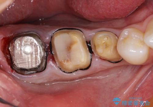 30代男性 奥歯の虫歯治療→セラミックによる修復の治療中