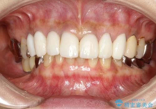前歯7本のオールセラミック(50代女性)の治療中