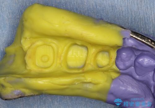 30代男性 奥歯の虫歯治療→セラミックによる修復の治療中