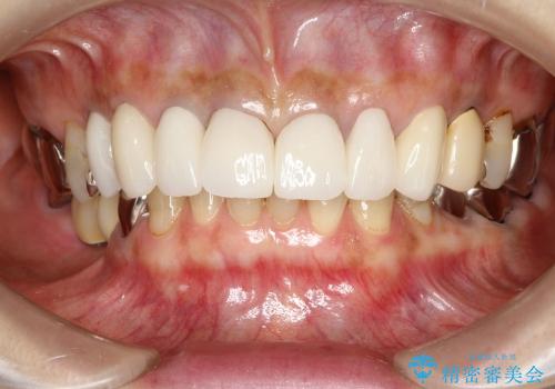前歯7本のオールセラミック(50代女性)の治療後