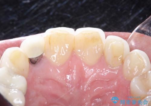 20代女性 前歯の部分矯正+オールセラミックの治療前